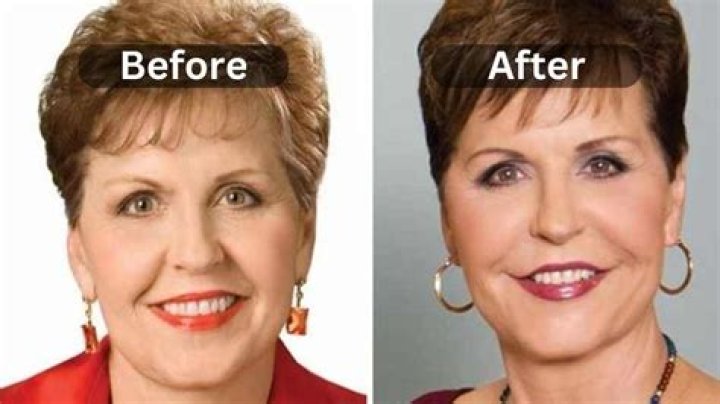 Joyce Meyer's Facelift Journey Unveiled