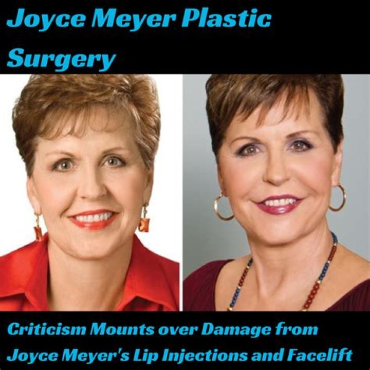 Joyce Meyer's Plastic Surgery Journey: Uncovering The Truth