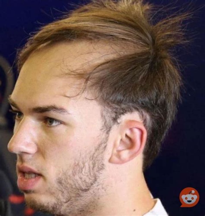Pierre Gasly's Hair Loss Journey