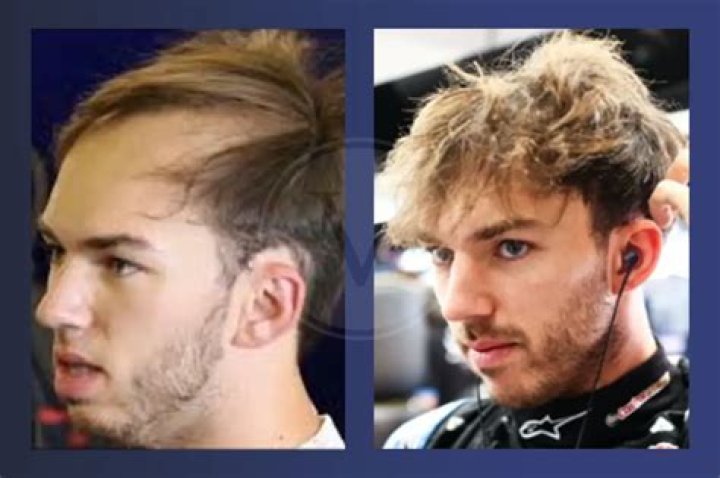 Unveiling The Resilience And Empowerment Behind "Pierre Gasly Bald"