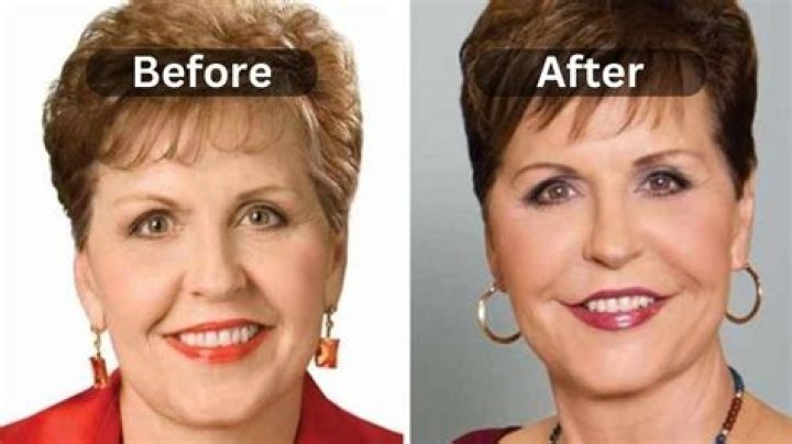 Unveiling The Transformative Journey Of Joyce Meyer's Weight Loss Surgery